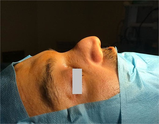 Pollybeak deformity of the nose with dorsal nasal cyst (arrow).