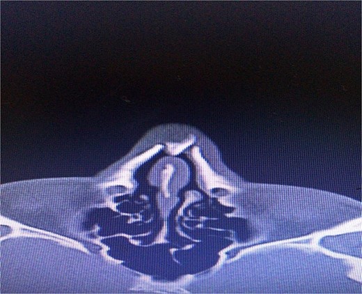 Postoperative computed tomography showing alterations in the nasal dorsum and bone remodeling.