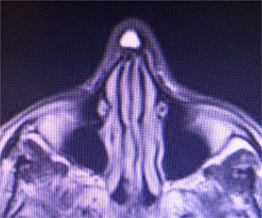 T2-weighted magnetic resonance imaging demonstrating a hyperintense, well defined, 2 × 2 cm lesion in the operative area of the nasal dorsum.