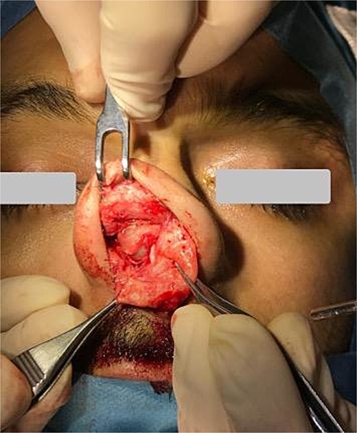 Total excision of the cystic content using an open rhinoplasty approach.