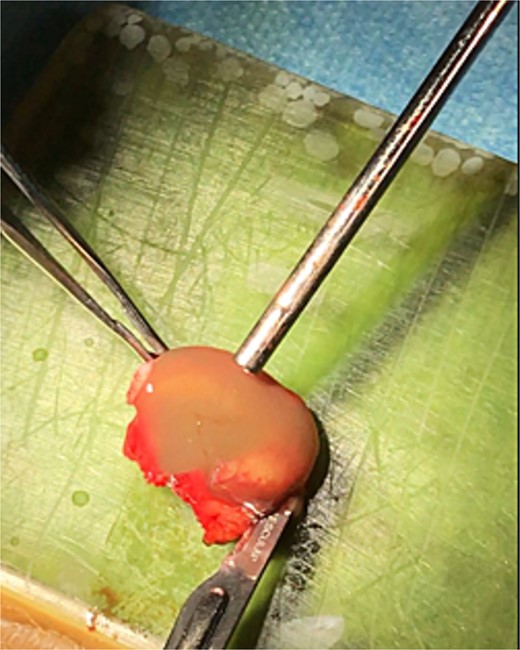 Total excision of the cystic content using an open rhinoplasty approach.