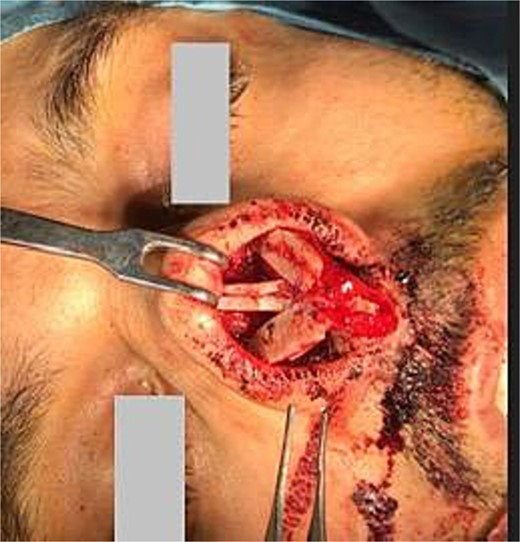 Nasal reconstruction using a costal cartilage graft and postoperative nasal appearance.