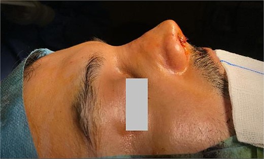 Nasal reconstruction using a costal cartilage graft and postoperative nasal appearance.
