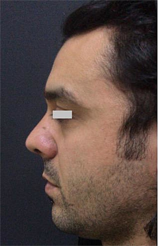 During postoperative follow-up, the nasal appearance was stable without cyst recurrence.