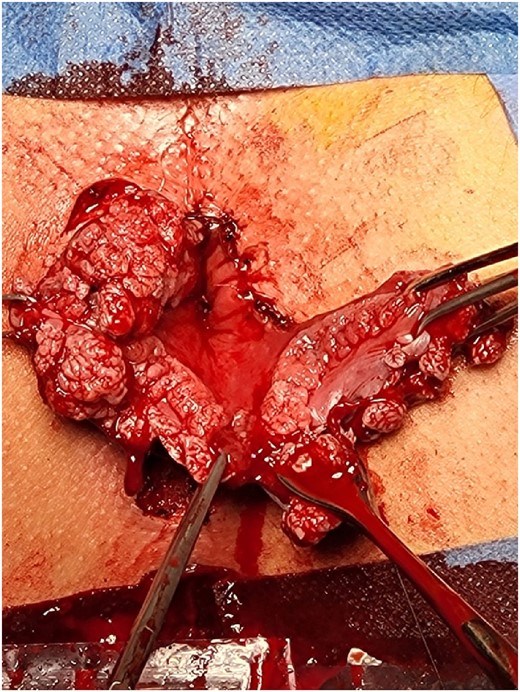 Beginning of the operation, massive wart-like masses with practically complete absence of healthy tissue.