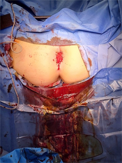 Result immediately after operation. No pathological tissues remain.