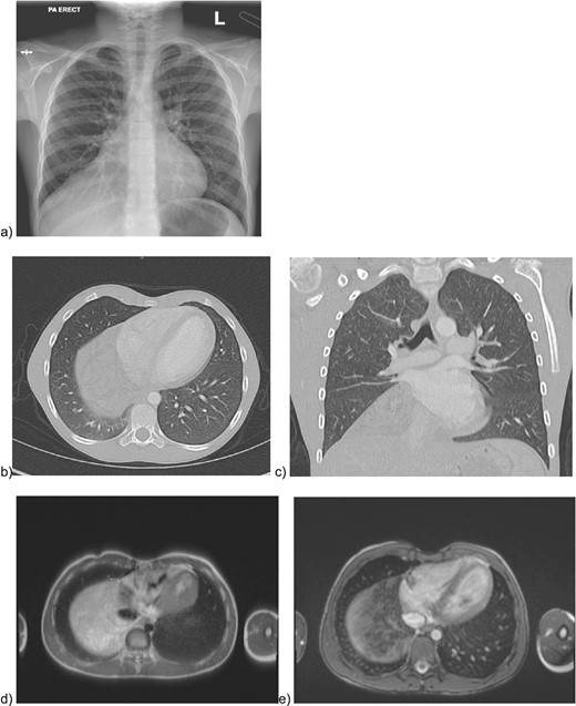 Preoperative imaging of the mediastinal mass. a) CXR illustrating the obscured right hemidiaphragm that was incidentally detected leading to further workup; b) axial and c) coronal CT images with intravenous contrast; e) MRI imaging with axial T2 HASTE sequence f) MRI axial VIBE sequence.