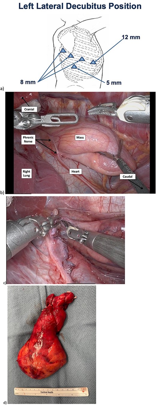 Intraoperative imaging of mediastinal mass dissection. a) Positioning and port placement. At completion the 12 mm port was upsized to 2.5 cm for specimen extraction. b) Prior to beginning resection, phrenic nerve easily visualized, mass overlying heart in usual thymic position. c) Cervical dissection with pedicles of two thymic vessels which were encircled and clipped. d) Resected mass.