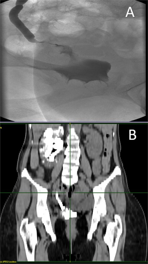 A: Diagnostic nephrotomography showing the existence of an UVF. B: CT nephrotomography showing the abnormal passage of intravenous contrast enhancement fluid from the ureter to vagina, confirming the existence of an UVF.