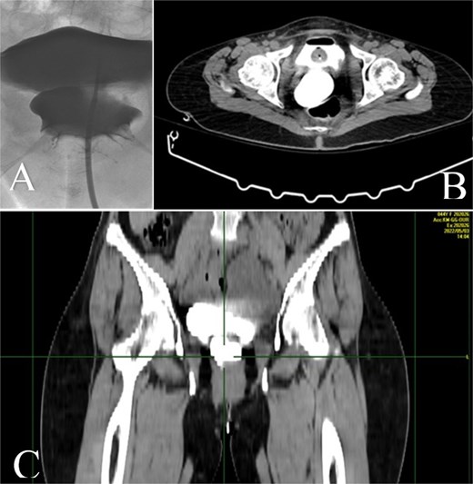 A: Retrograde cystography with contrast enhancement showing the existence of a VVF. B and C: CT cystography showing passage of contrast enhancement from the bladder to vagina, demonstrating the formation of a VVF.