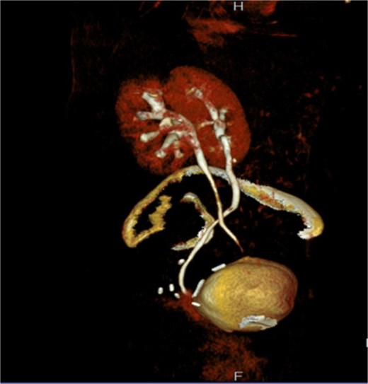 The 3D image of reimplantation of the right ureter with antireflux technique in the dome of the bladder.