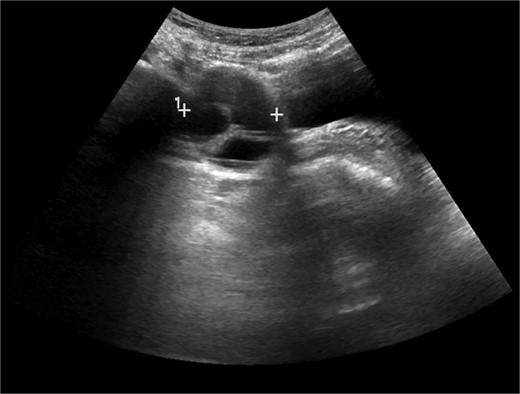 Transvaginal ultrasound image of right adnexa. Cystic structure with the measurement 4.2 × 3.7 × 3.6 cm at the time of imaging.
