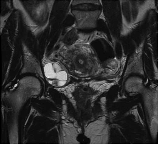 Coronal magnetic resonance imaging of the pelvis with contrast. Complex solid and cystic retroperitoneal mass abutting the right external iliac vessel, 4.4 cm × 4.0 cm × 3.8 cm in measurement.