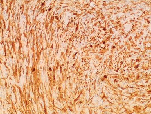 Photomicrograph of diagnostic histopathology showing strong and diffuse S100 immunohistochemical stain uptake by lesional cells.