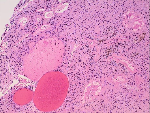 Photomicrograph of diagnostic histopathology showing cystic degeneration and hemorrhage with hemosiderin laden macrophages.