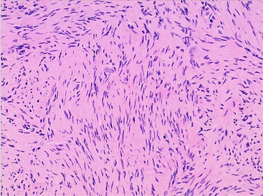 Photomicrograph of diagnostic histopathology showing elongated wavy cells with tapered ends of nuclei and modest amount of cytoplasm.