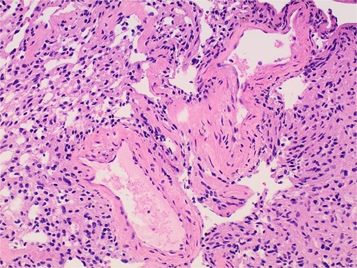 Photomicrograph of diagnostic histopathology showing thickened blood vessel walls with hyalinization.