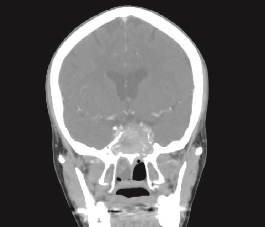 CT brain, coronal reconstruction shows bilateral near total opacification and expansion of the paranasal sinuses and nasal cavity. Invasion of the left cavernous sinus with encasement of cavernous segment of left ICA. Pituitary gland and optic chiasm displaced superiorly.