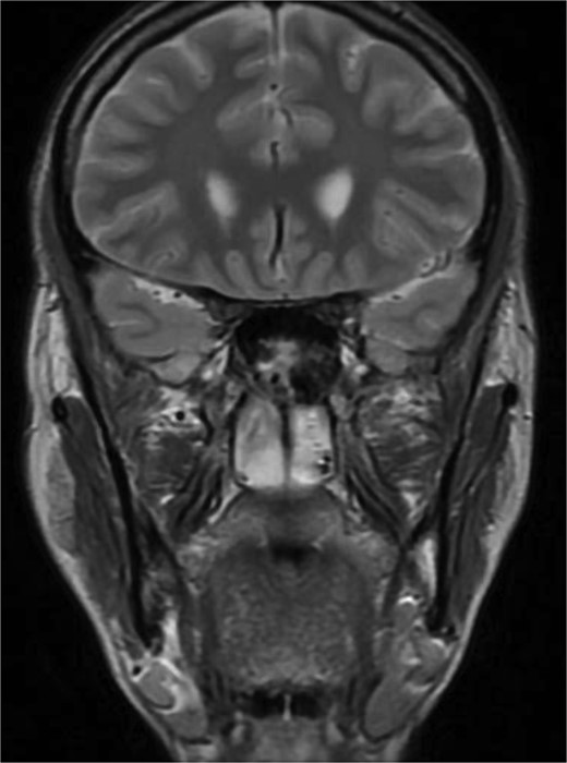 MRI of paranasal sinuses shows the sphenoid sinus is expanded and bulging superiorly into the pituitary fossa causing displacement of pituitary gland and stalk without mass effect upon the optic chiasm. It extends laterally causing effacement of the cavernous sinus.