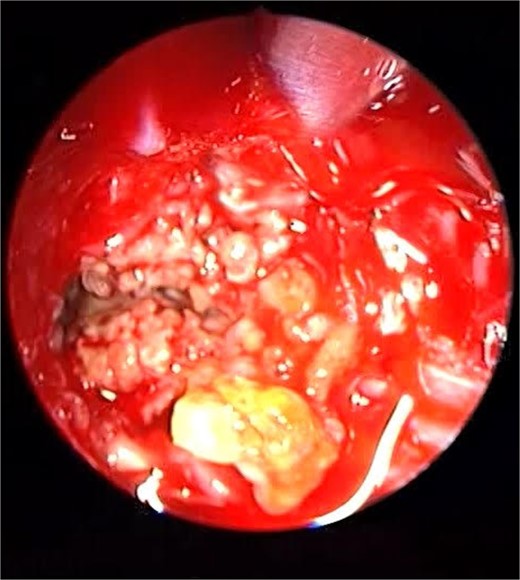 Endoscopic intraoperative view of the sphenoid sinus full of fungal mud and mucin.