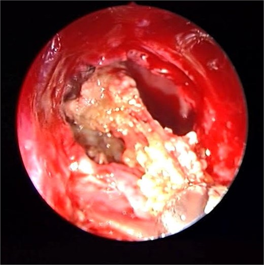 The thick fungal mucin is removed from the sinus.