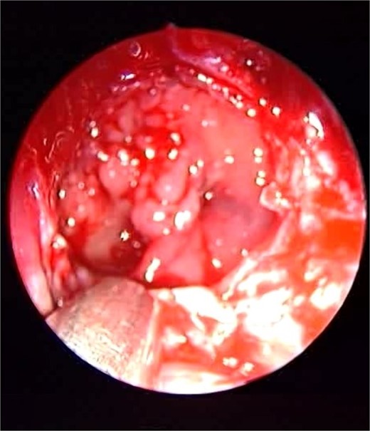 Endoscopic intraoperative image of the sphenoid sinus post removal of the fungal mud and mucin from the lateral wall of the sphenoid sinus.