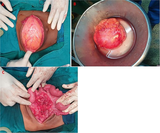 (A) Huge mesenteric lipoma, (B) lipoma excised whole, (C) cavity after excision of mesenteric lipoma.