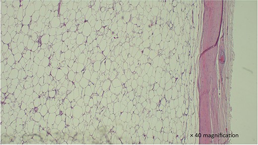 H & E stained section show a section with proliferation of well-circumscribed mature adipocytes without atypia. which is well circumscribed.