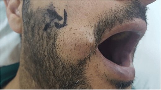 Image showing the mass on the right cheek region (arrow pointed to the mass). The mass was ~4 cm by 3 cm in size, painless, firm, and mobile.