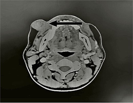 CT scan showed the tumor (arrow). Axial view of head CT scan revealing a mass above the right parotid gland.