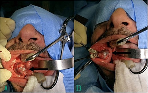 (A, B) showing images of the tumor intraoperatively (arrow).