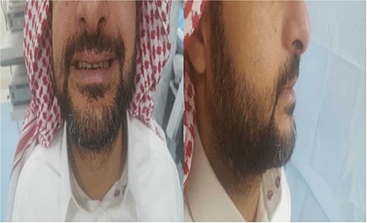 Patient’s face 2 weeks post-surgery follow-up visit. No visible scar or any facial asymmetry was seen