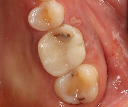Preoperative intraoral view.