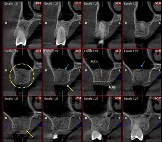 CBCT view 12 months after surgery.