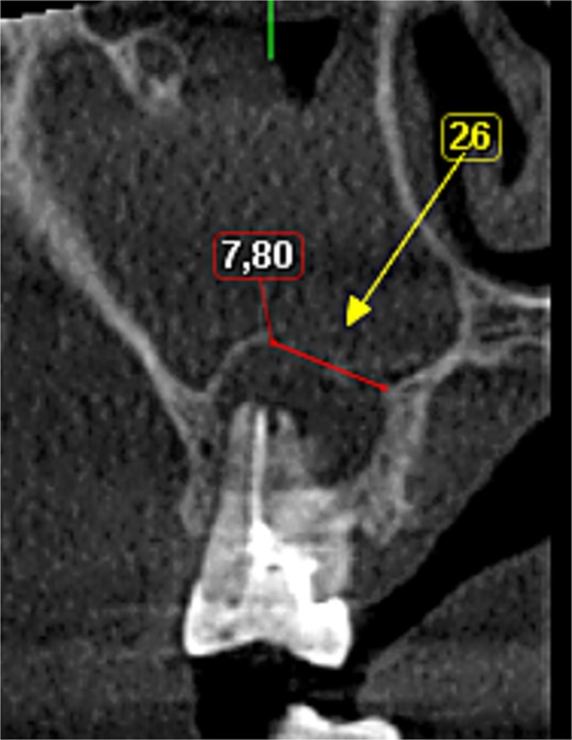 Preoperative CBCT view.
