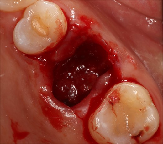 Socket view after extraction.