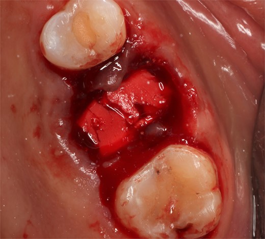 Collagen sponge inside the socket.