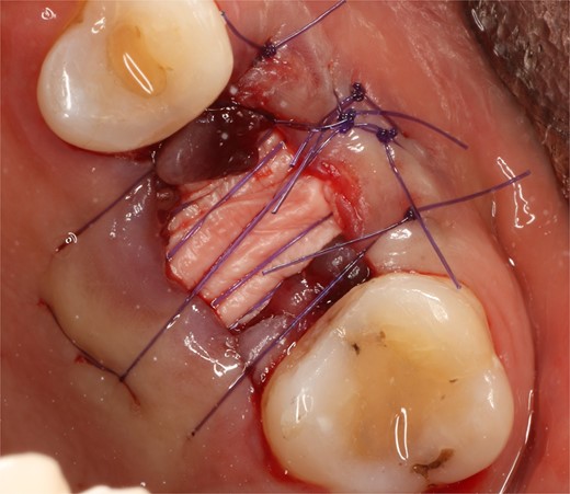 Stabilization of collagen membrane.