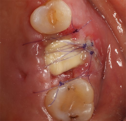 Follow-up at 8 days after surgery.