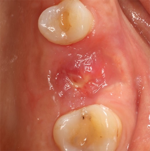 Follow-up at 4 weeks after surgery.
