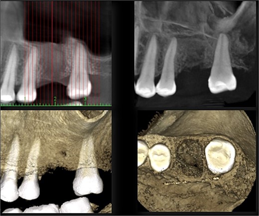 CBCT 3 months after surgery.