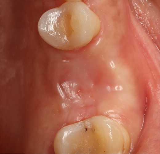 Follow-up at 6 months after surgery.