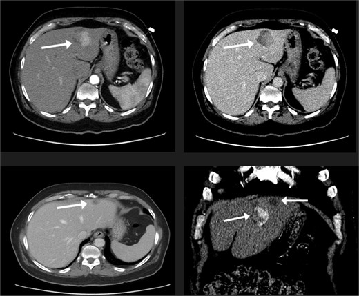 The liver lesions in segment II. The largest lesion is 3.3 × 3.4 cm and demonstrates arterial enhancement and faint washout in the delayed phase. In the portovenous phase, the smaller lesion is 1.2 × 1.1 cm.