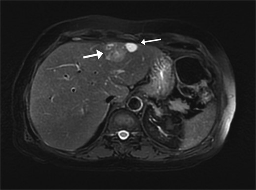Two segment II hepatic lesions: the larger lesion is consistent with clear cell variant hepatocellular carcinoma and the second, more cranial lesion, is likely metastasis from a mucinous adenocarcinoma.