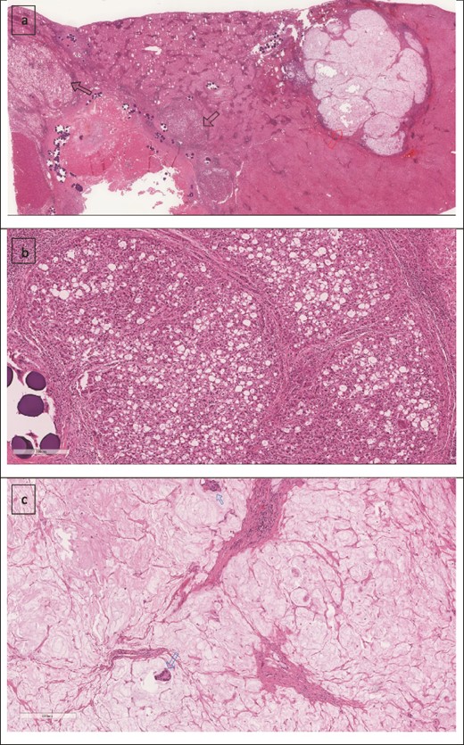 (a) Low power image showing two foci of metastatic mucinous colorectal adenocarcinoma (right arrow) and the treated hepatocellular carcinoma (left arrow). (b) Higher power image showing the hepatocellular carcinoma component. (c) Mucinous adenocarcinoma with two malignant glands.