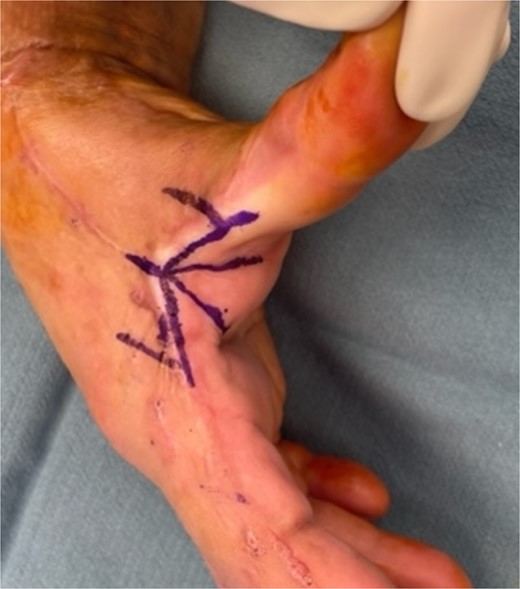 Marking of a five flap Z-plasty along a scar of 3 cm. The V to Y advancement flap originates from the more pliable palmar side.