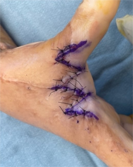 Inset of the five flap Z-plasty in Fig. 1, resulting in increase in length from 3 cm to almost 7 cm.