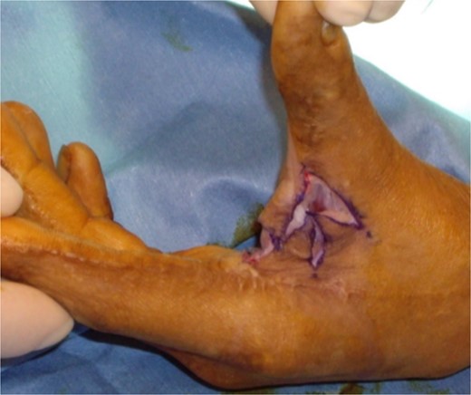 Four flap z-plasty with flaps elevated, prior to suturing. The limbs here are 2 cm, and in this case, the four flaps are designed at 60-degree angles.