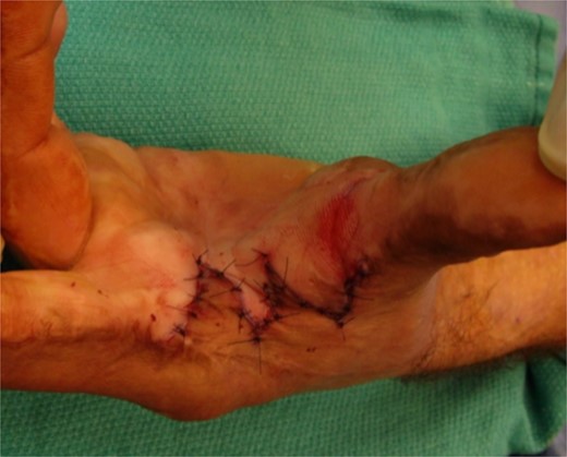 Inset of four flap Z-plasty in Fig. 3. The resulting scar is just over 4 cm in length.