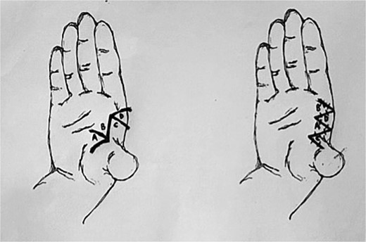Incisions for webspace release with 60-degree four-flap z-plasty showing initial and final positions of flaps A–D. Note all limbs are of equal length, including the central limb.